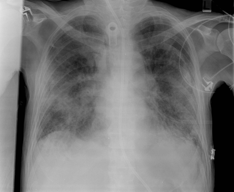 Röntgenbild von einem Brustkorb